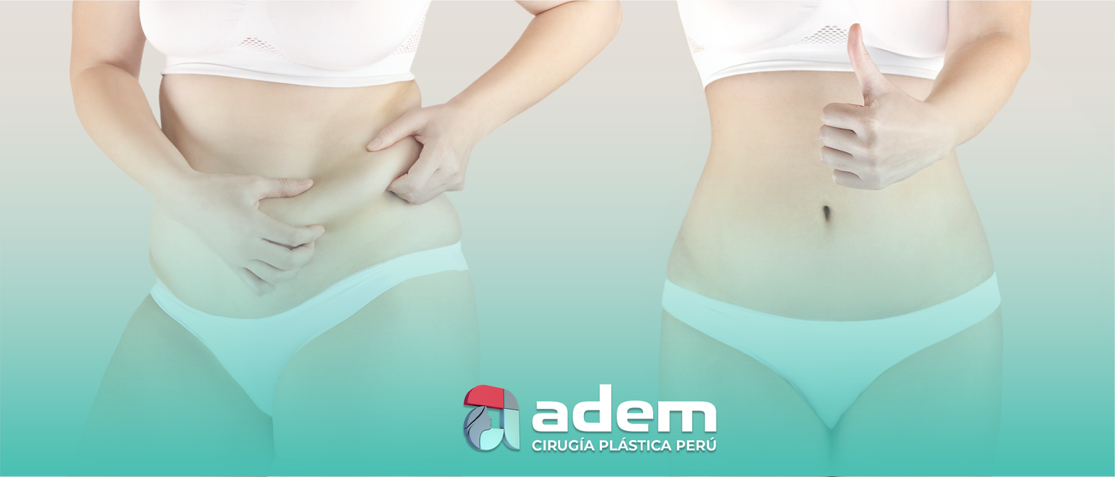 Tipos de ABDOMINOPLASTIA en Perú ADEM CIRUGÍA PLÁSTICA