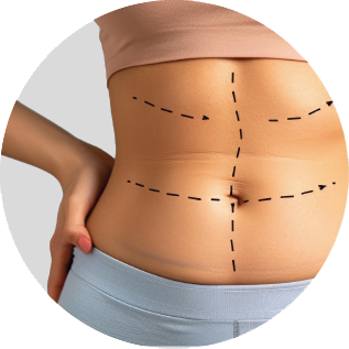 ABDOMINOPLASTIA