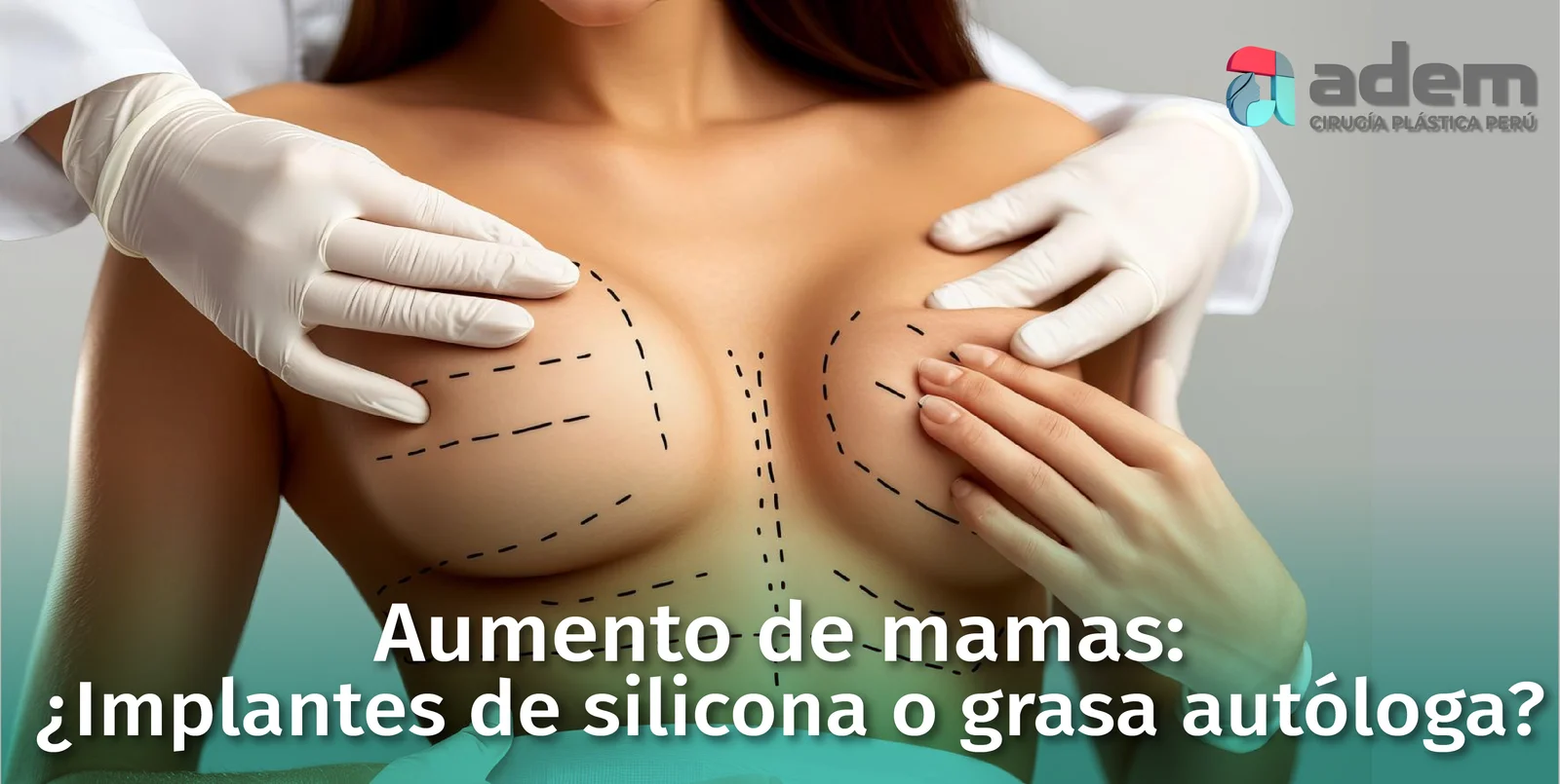 Aumento de Mamas: Implantes de Silicona vs. Grasa Autóloga – ¿Cuál Elegir?