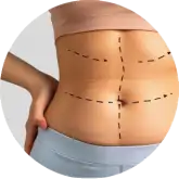 Abdominoplastia ADEM