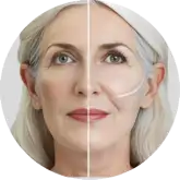 Lifting Facial ADEM
