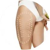 Aumento Muslo - ADEM