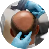 Implante Capilar - ADEM